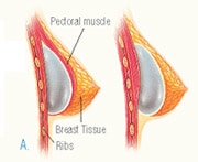 Breast augmentation sketch