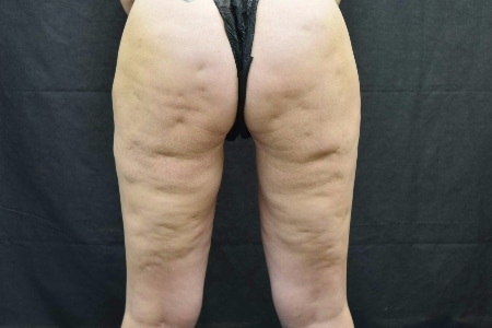 back of patient’s legs before cellfina cellulite treatment