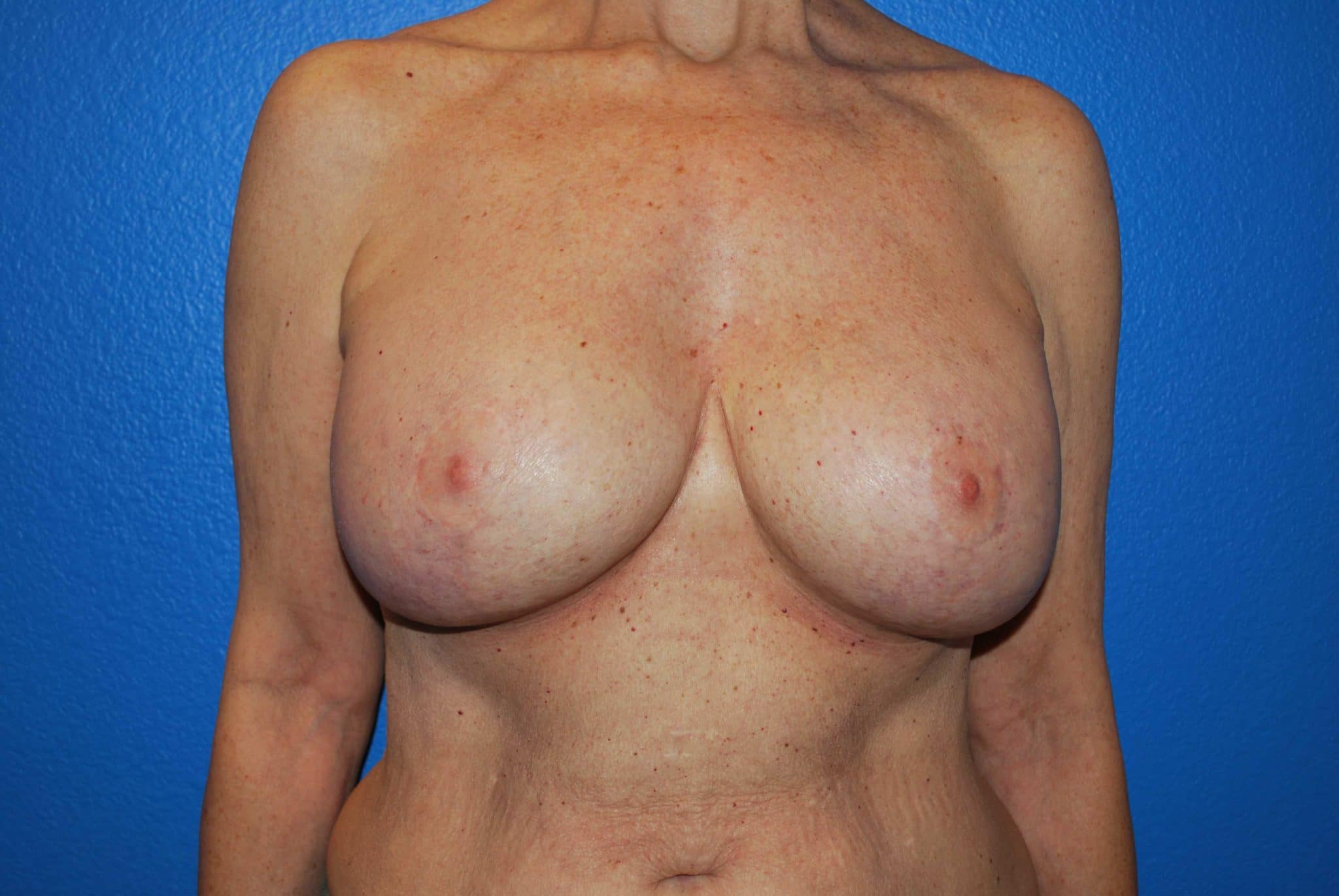 after breast implant exchange surgery