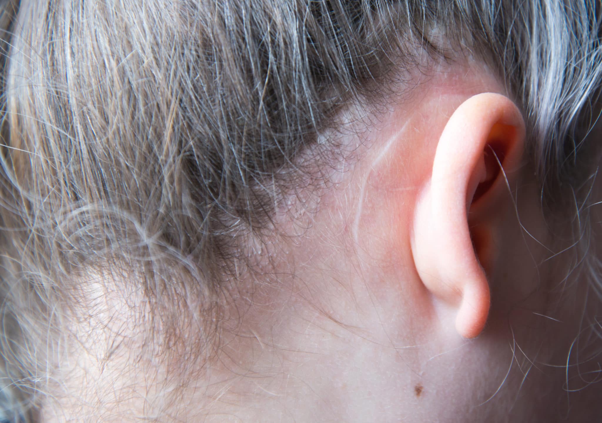 Operation scar behind ear
