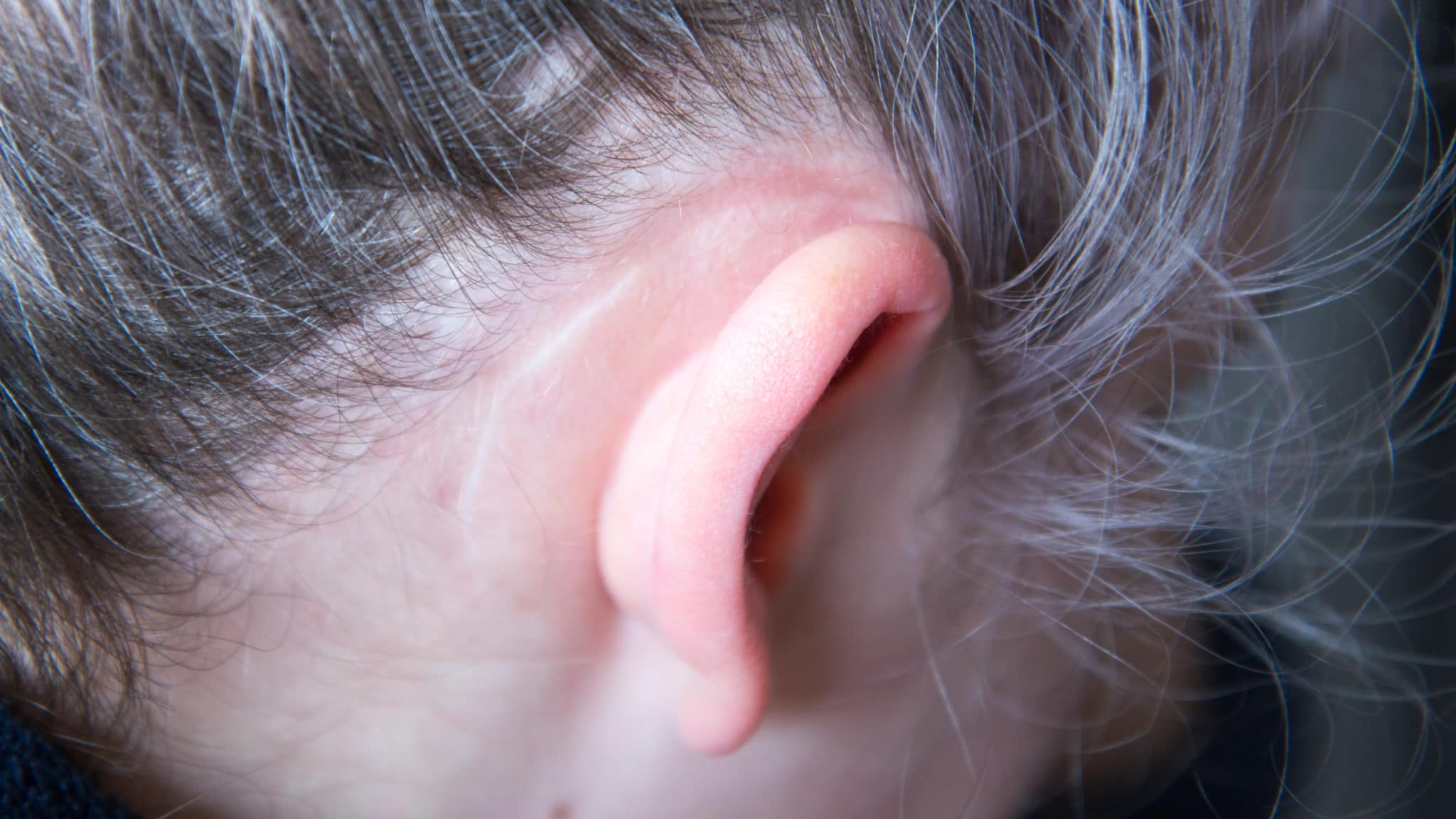 Operation scar behind ear
