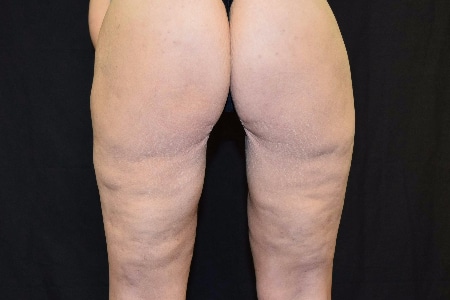 back of patient’s legs after cellfina treatment, cellulite not visible after treatment