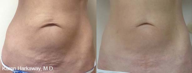 thermitight rf skin tightening procedure before and after dr. phillip dahan