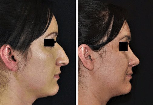rhinoplasty nose reshaping