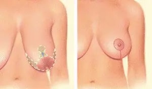 breast lift.jpg