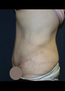 Body Contouring after Major Weight Loss Patient Patient # 54249