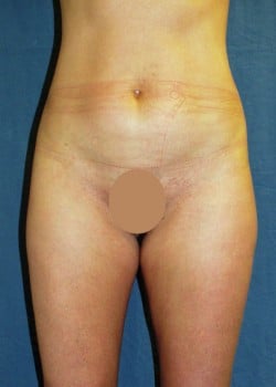 Liposuction Patient # 13201