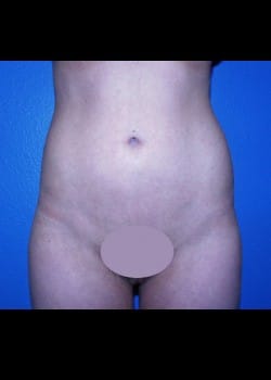 Liposuction Patient # 47382