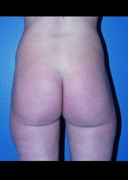 Liposuction Patient # 47382