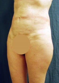 Liposuction Patient # 91555