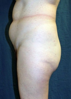 Liposuction Patient # 91555