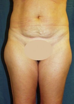 Liposuction Patient # 87485