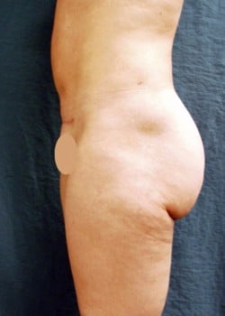 Liposuction Patient # 87485