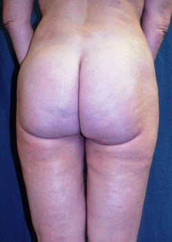 Liposuction Patient # 65844