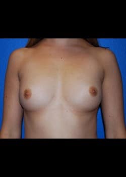 Breast Augmentation Patient # 38972