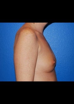 Breast Augmentation Patient # 88632