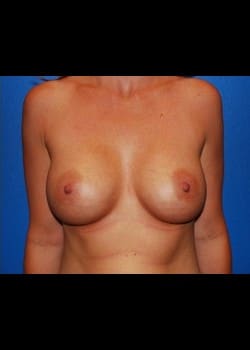 Breast Augmentation Patient # 20334