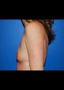 Breast Augmentation Patient # 20334