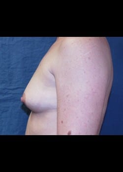 Breast Augmentation Patient # 71450