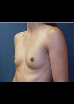 Breast Augmentation Patient # 42194