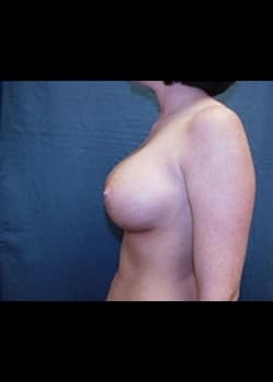 Breast Augmentation Patient # 61605