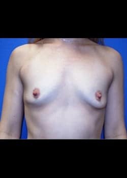 Breast Augmentation Patient # 73730