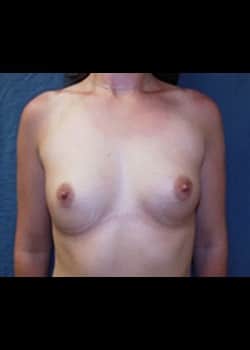 Breast Augmentation Patient # 37555