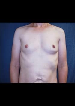 Breast Augmentation Patient # 76841
