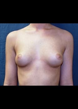 Breast Augmentation Patient # 23873