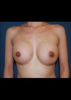 Breast Augmentation Patient # 63707