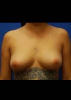 Breast Augmentation-Gel Patient # 75504