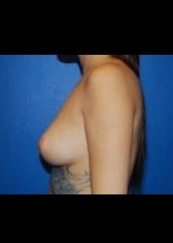 Breast Augmentation-Gel Patient # 75504