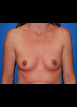 Breast Augmentation-Gel Patient # 2516