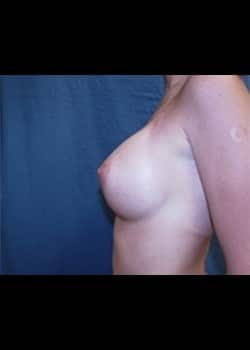 Breast Augmentation-Gel Patient # 37555
