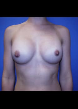 Breast Augmentation-Gel Patient # 87929