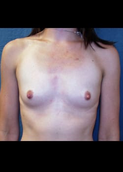 Breast Augmentation-Gel Patient # 87929