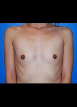 Breast Augmentation-Gel Patient # 63707