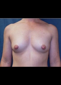 Breast Augmentation-Saline Patient # 71450