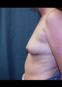 Breast Augmentation-Saline Patient # 87038