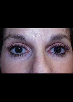 Eyelid Surgery Patient # 62858