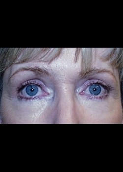 Eyelid Surgery Patient # 64502