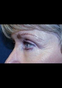 Eyelid Surgery Patient # 64502