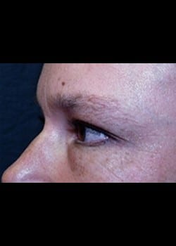 Eyelid Surgery Patient # 78858