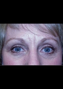 Eyelid Surgery Patient # 83489