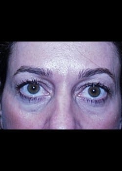 Eyelid Surgery Patient # 34714