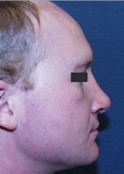 Nose Surgery Patient # 65042