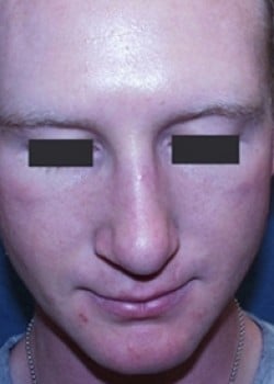 Nose Surgery Patient # 65043