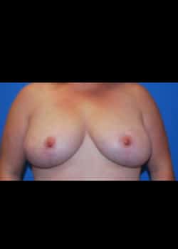 Breast Lift Patient # 6011
