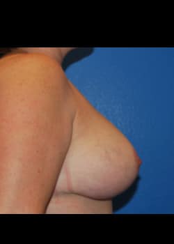 Breast Lift Patient # 6011