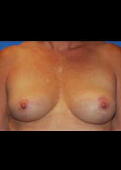 Breast Lift Patient # 6020